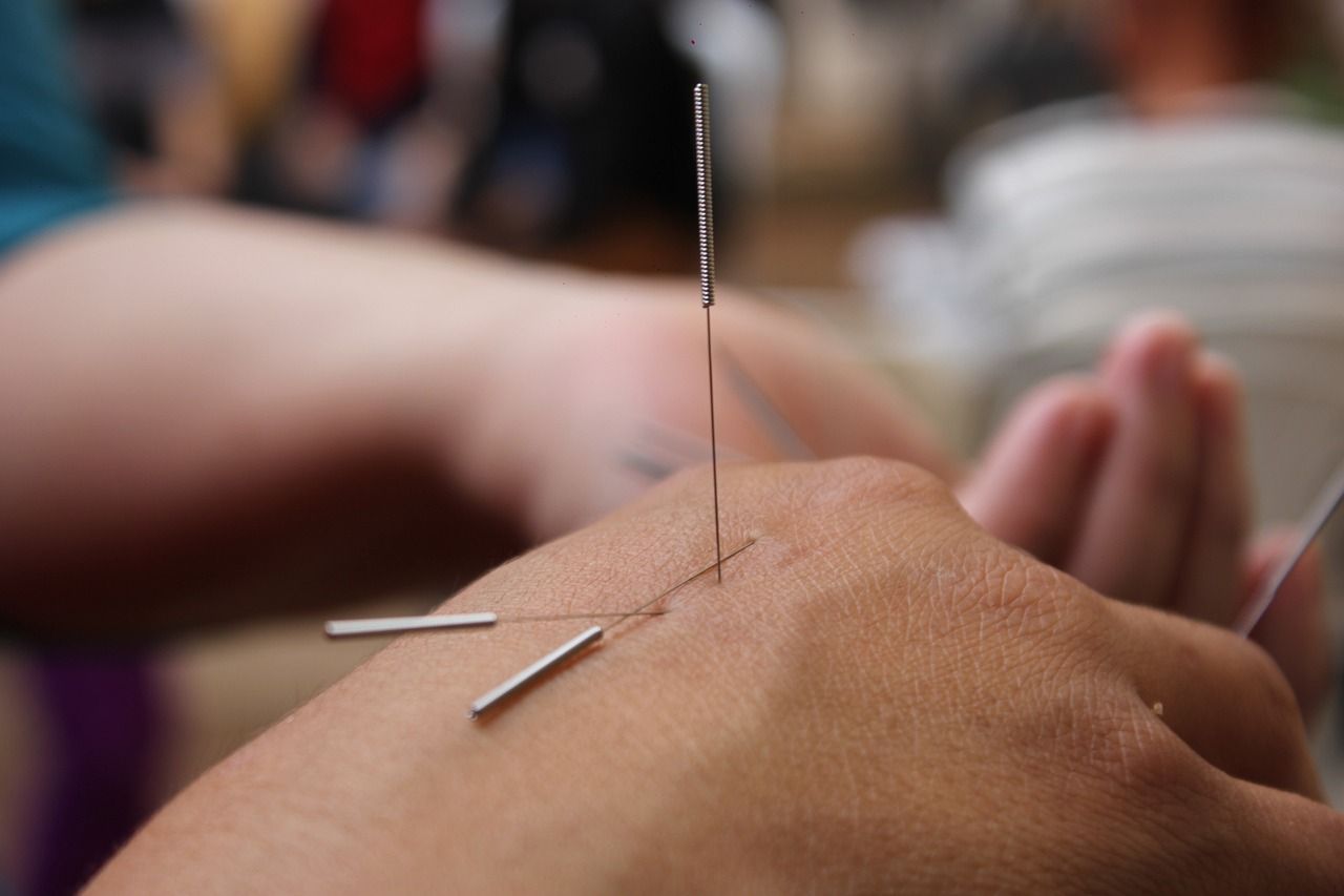 Akupunktura – starożytne metody lecznicze w nowoczesnym wydaniu